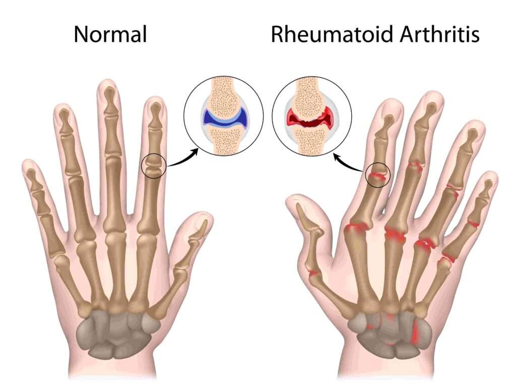 Close-up of a hand with swollen and deformed joints due to rheumatoid arthritis.